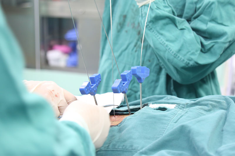 腰椎管减压融合固定术